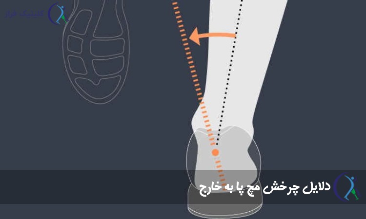 دلایل چرخش مچ پا به خارج