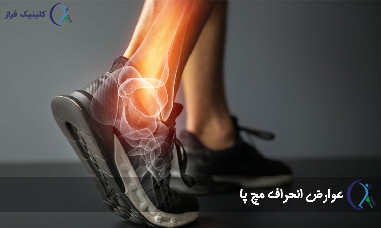 عوارض انحراف مچ پا