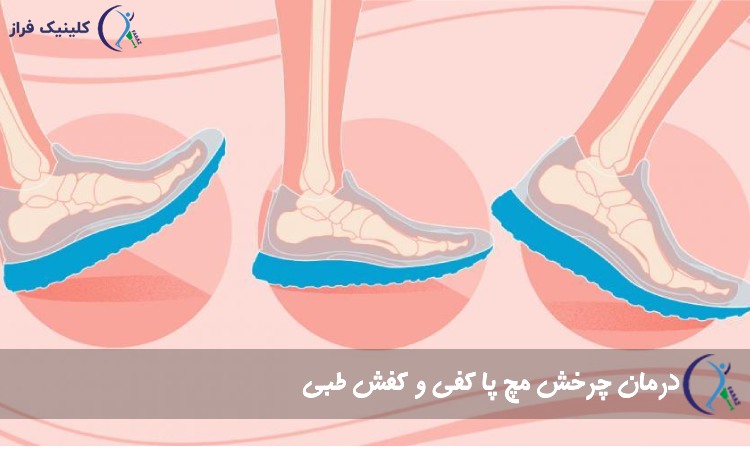 درمان چرخش مچ پا کفی و کفش طبی