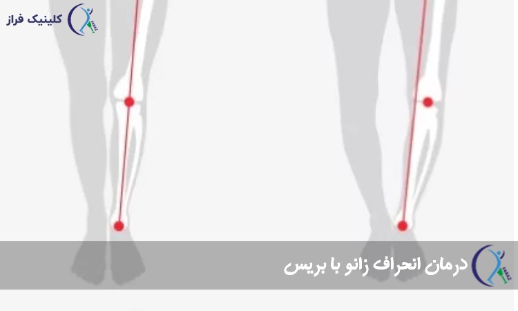 درمان انحراف زانو با بریس