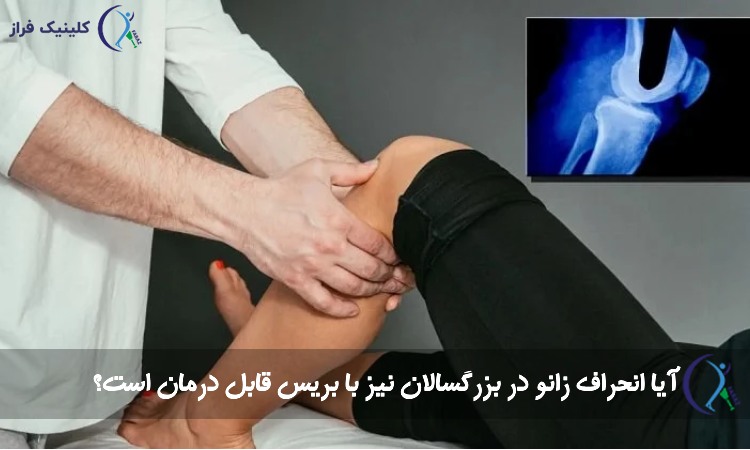 درمان انحراف زانو در بزرگسالان