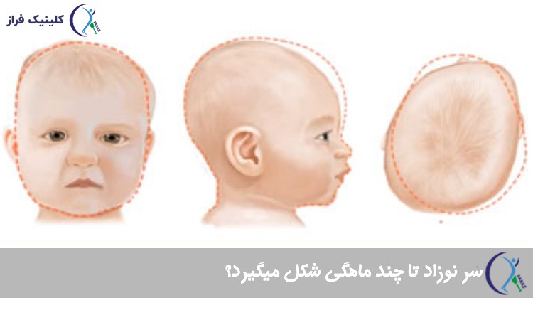 درمان بدشکلی سر نوزاد