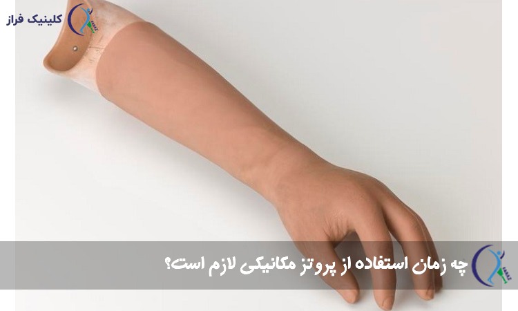 استفاده از پروتز مکانیکی