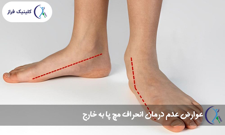 عوارض عدم درمان انحراف مچ پا به خارج