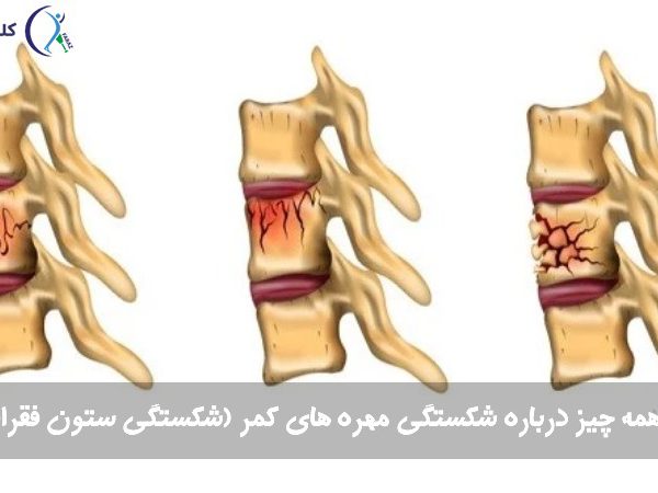 شکستگی مهره های کمر