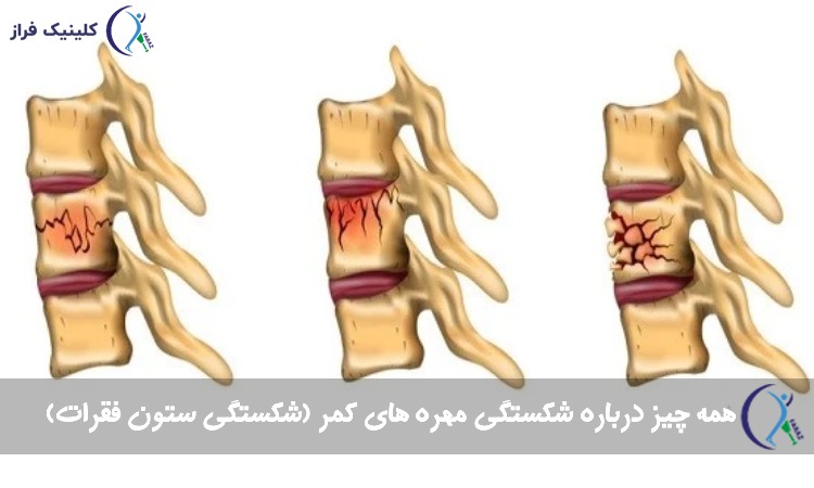 شکستگی مهره های کمر