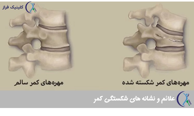 علائم و نشانه های شکستگی کمر