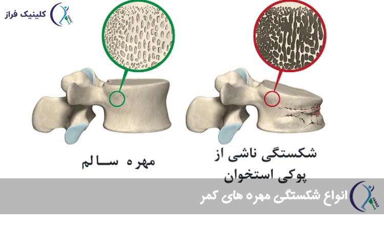 انواع شکستگی مهره های کمر