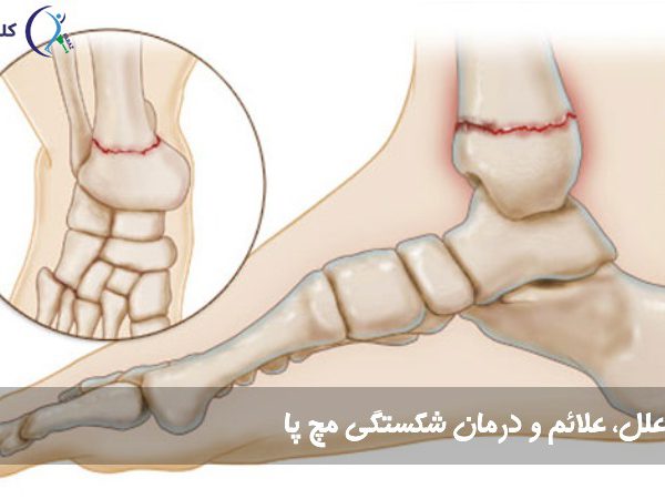 شکستگی مچ پا