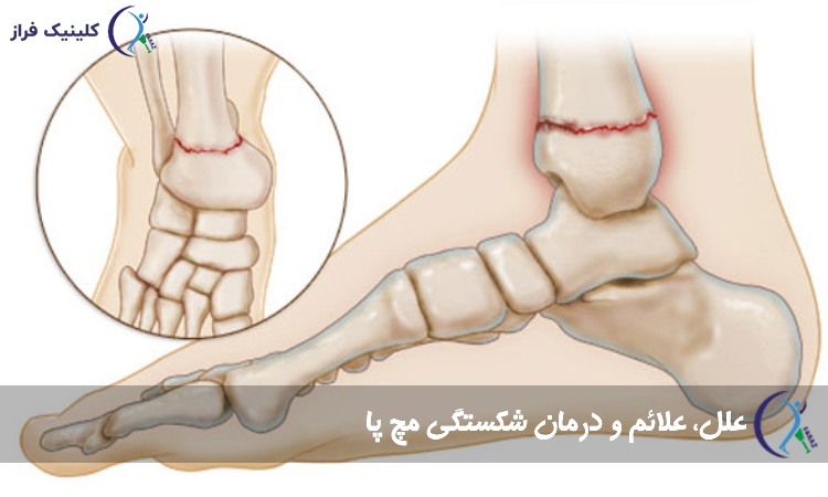 شکستگی مچ پا