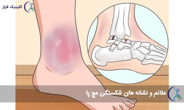 از کجا بفهمیم مچ پا شکسته است