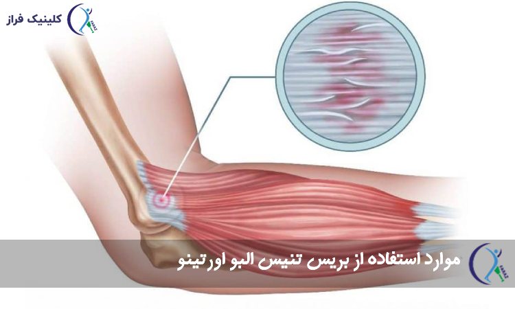 کاربرد بریس تنیس البو 