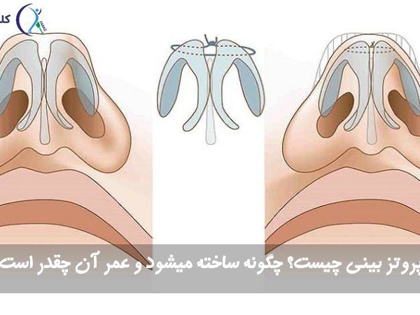 پروتز بینی
