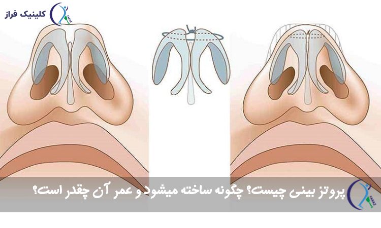 پروتز بینی