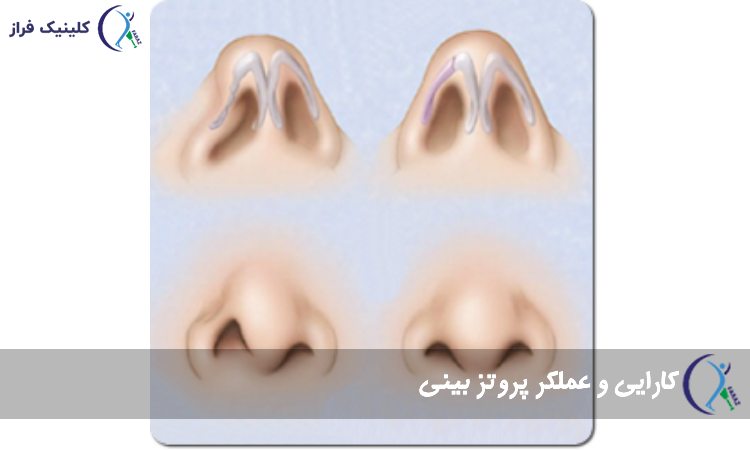 ترمیم بینی