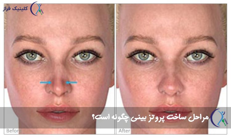 مراحل ساخت پروتز بینی