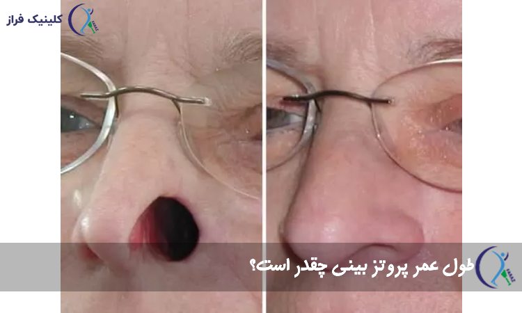 طول عمر پروتز بینی