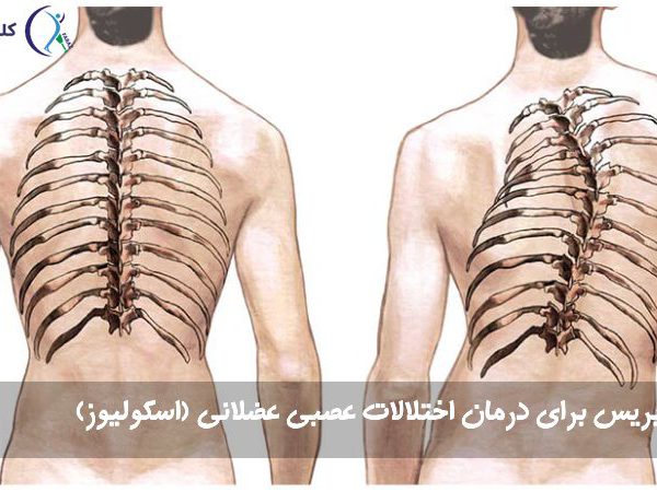 بریس اختلالات عصبی عضلانی