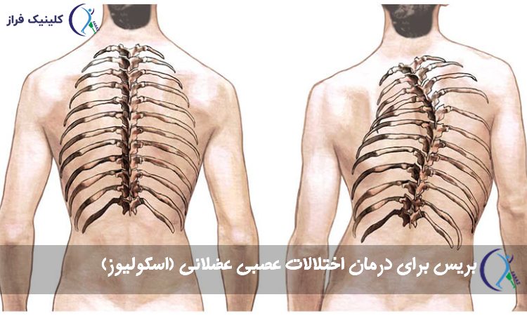 بریس اختلالات عصبی عضلانی