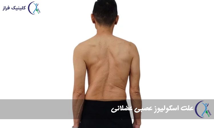 علت اسکولیوز عصبی عضلانی