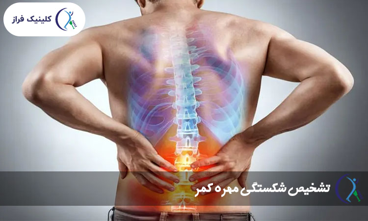 تشخیص شکستگی مهره کمر