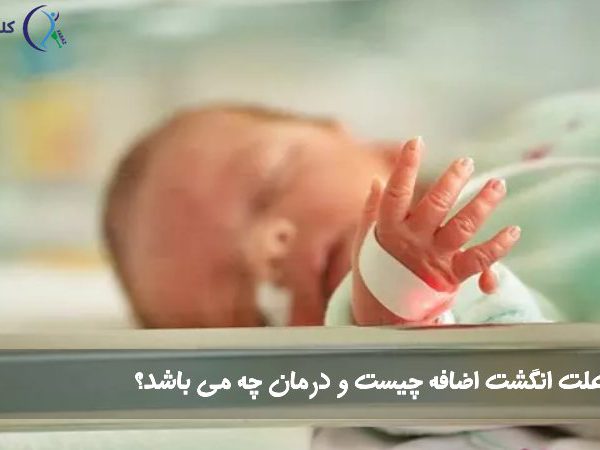 انگشت اضافه