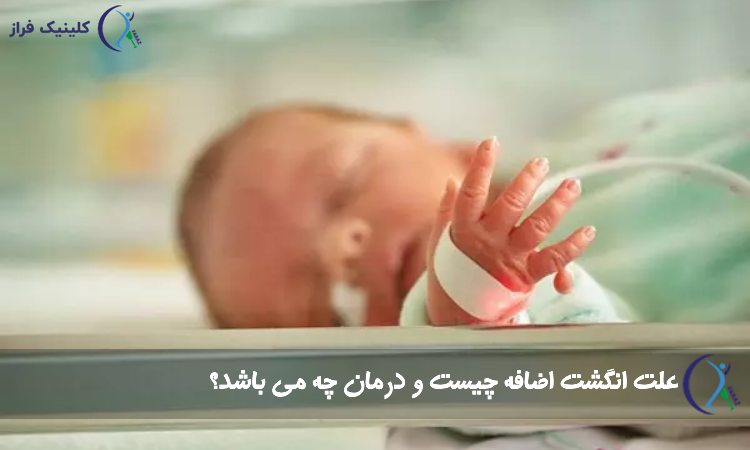 انگشت اضافه