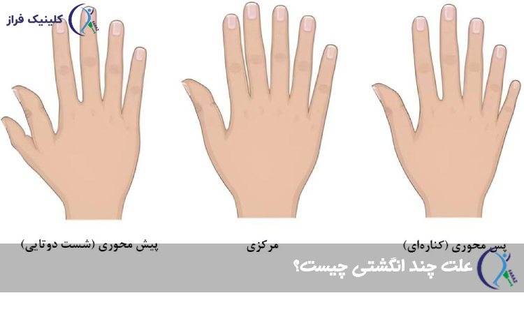 علت چند انگشتی