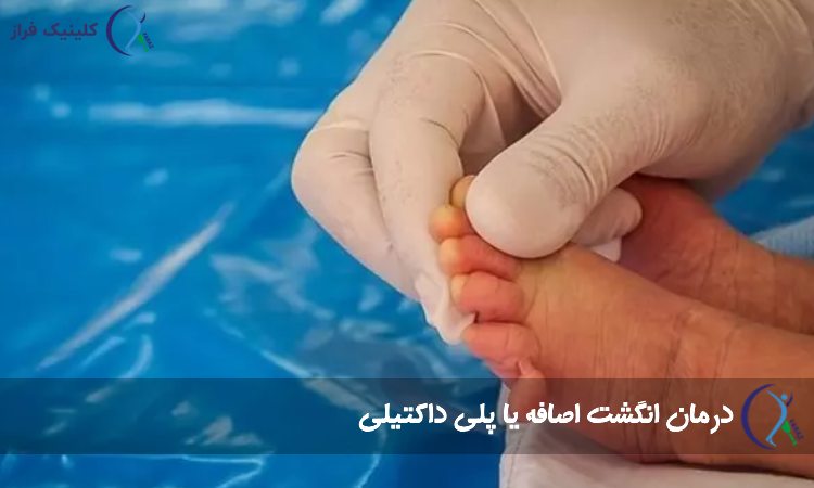 درمان انگشت اضافه یا پلی داکتیلی