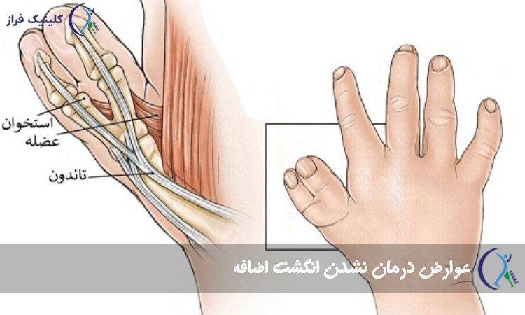 عوارض درمان نشدن انگشت اضافه