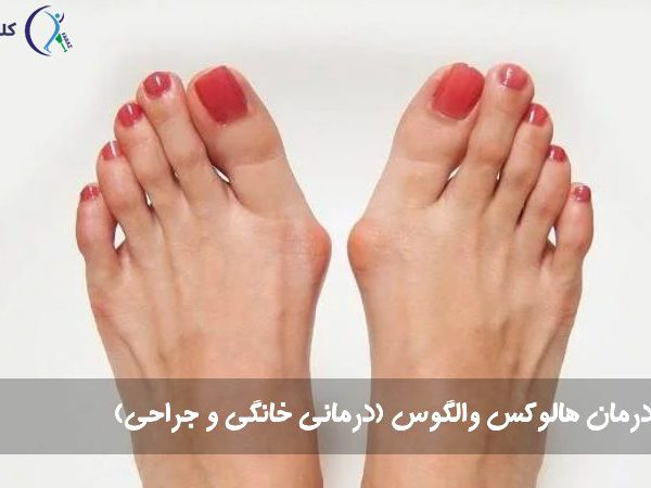درمان هالوکس والگوس