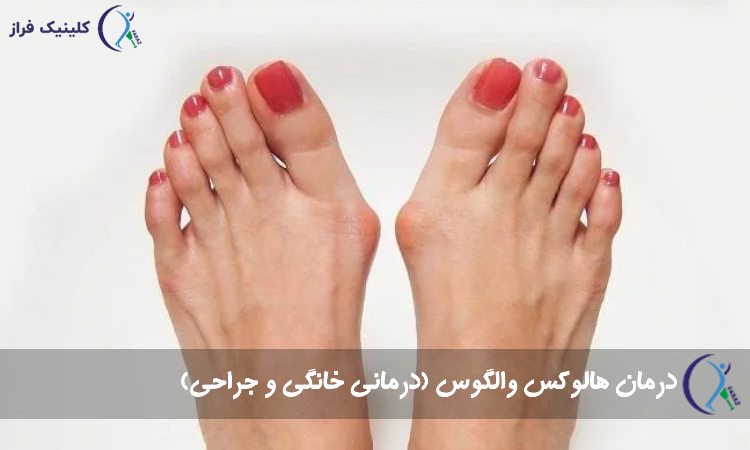 درمان هالوکس والگوس