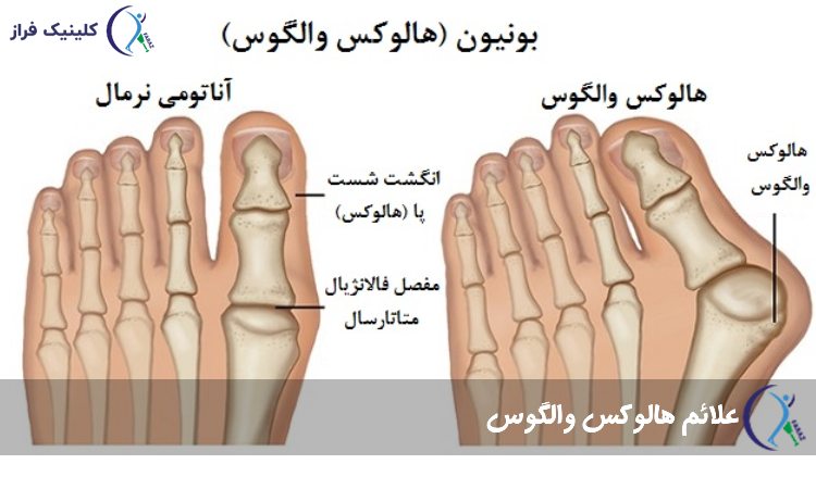 علائم هالوکس والگوس