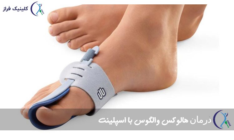 اسپلینت شست پا