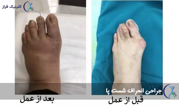 جراحی هالوکس والگوس