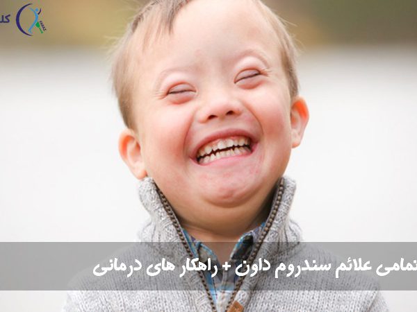 سندروم داون