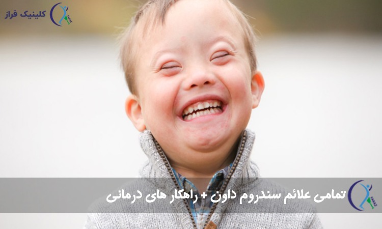 سندروم داون