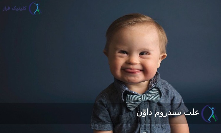 علت سندرم داون