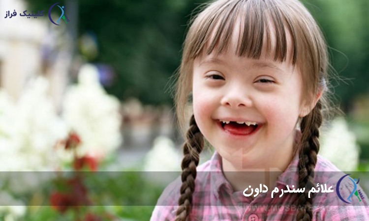 علائم سندرم داون