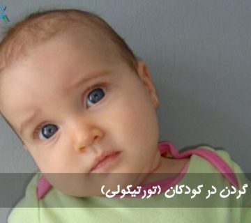 درمان کجی گردن در کودکان