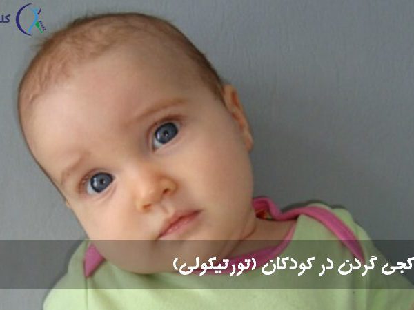 درمان کجی گردن در کودکان