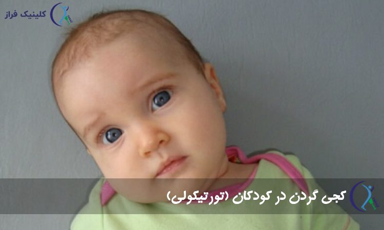 درمان کجی گردن در کودکان