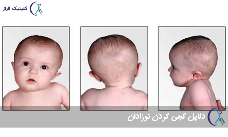 دلایل کجی گردن نوزادان