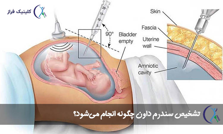 تشخیص سندرم داون چگونه انجام می‌شود؟ 