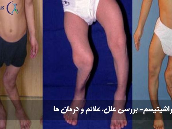 راشیتیسم | بررسی علل، علائم و درمان ها