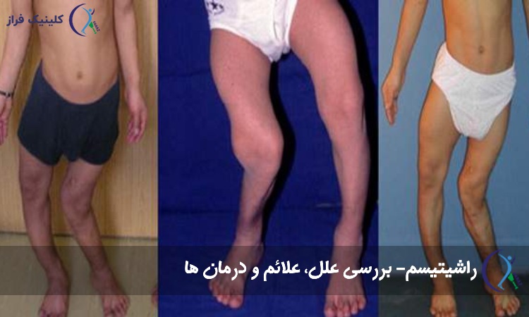 راشیتیسم | بررسی علل، علائم و درمان ها
