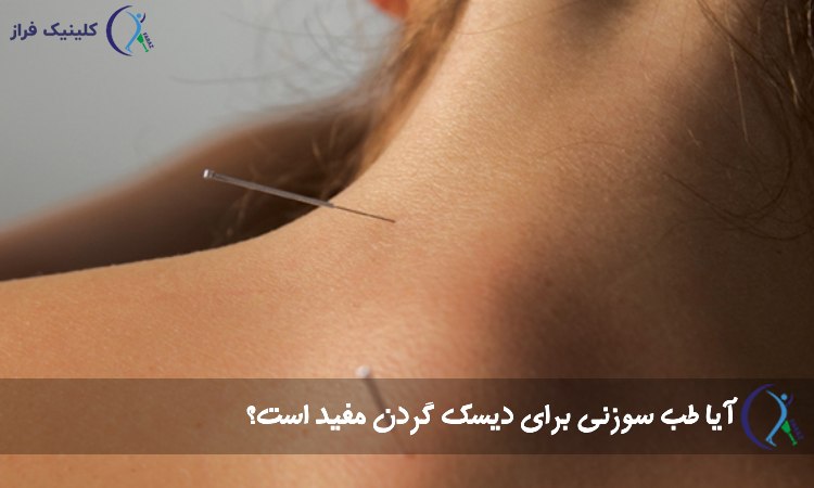 طب سوزنی برای درمان دیسک گردن