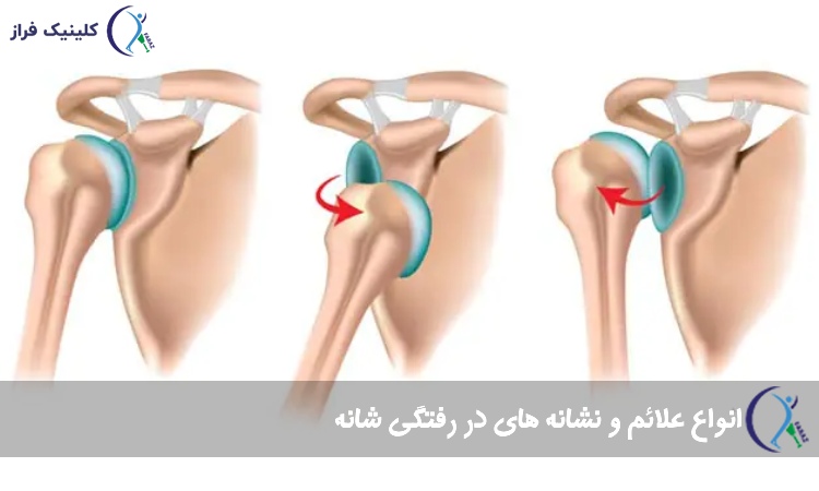 علائم و نشانه های در رفتگی شانه