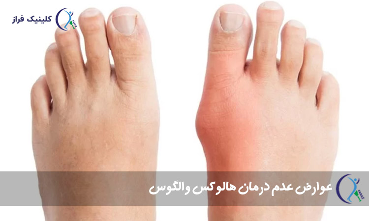 هالوکس والگوس