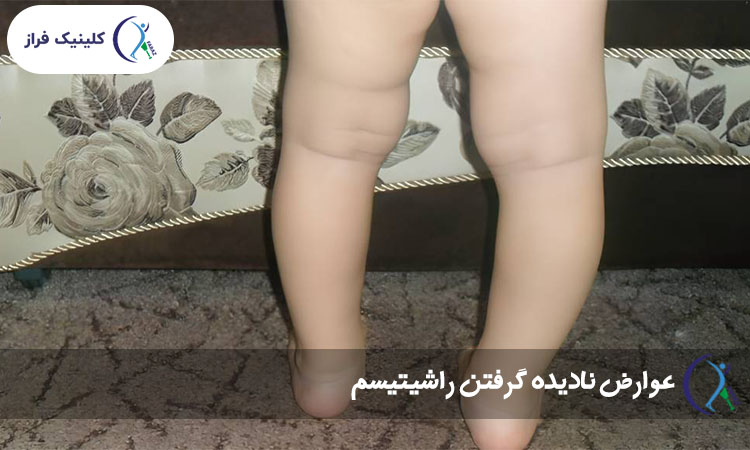عوارض نادیده گرفتن راشیتیسم